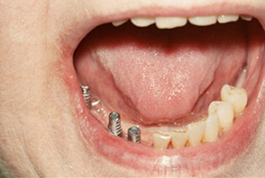 Swansea Dental Implant 1