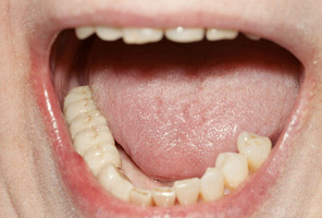 Swansea Dental Implant 3